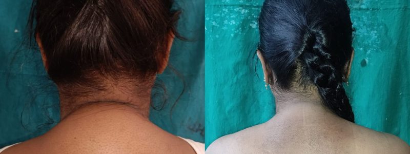 back-liposuction