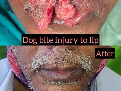 dog-bite-under-lip