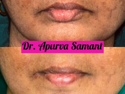 lip-contouring