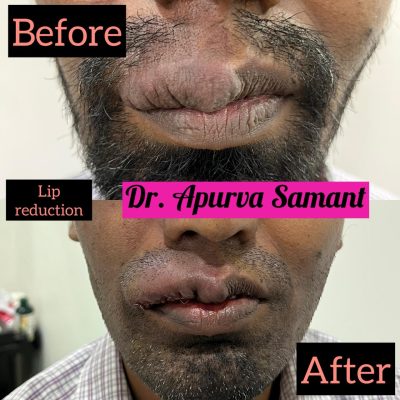 lip-reduction