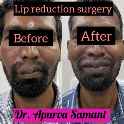 lip-reduction-surgeries
