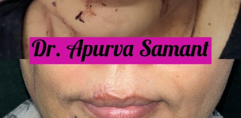 lip-surgeries
